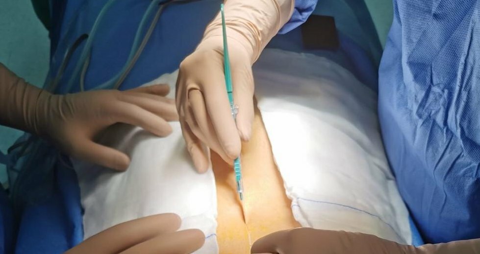 In Sicilia asportato raro tumore di 30 centimetri