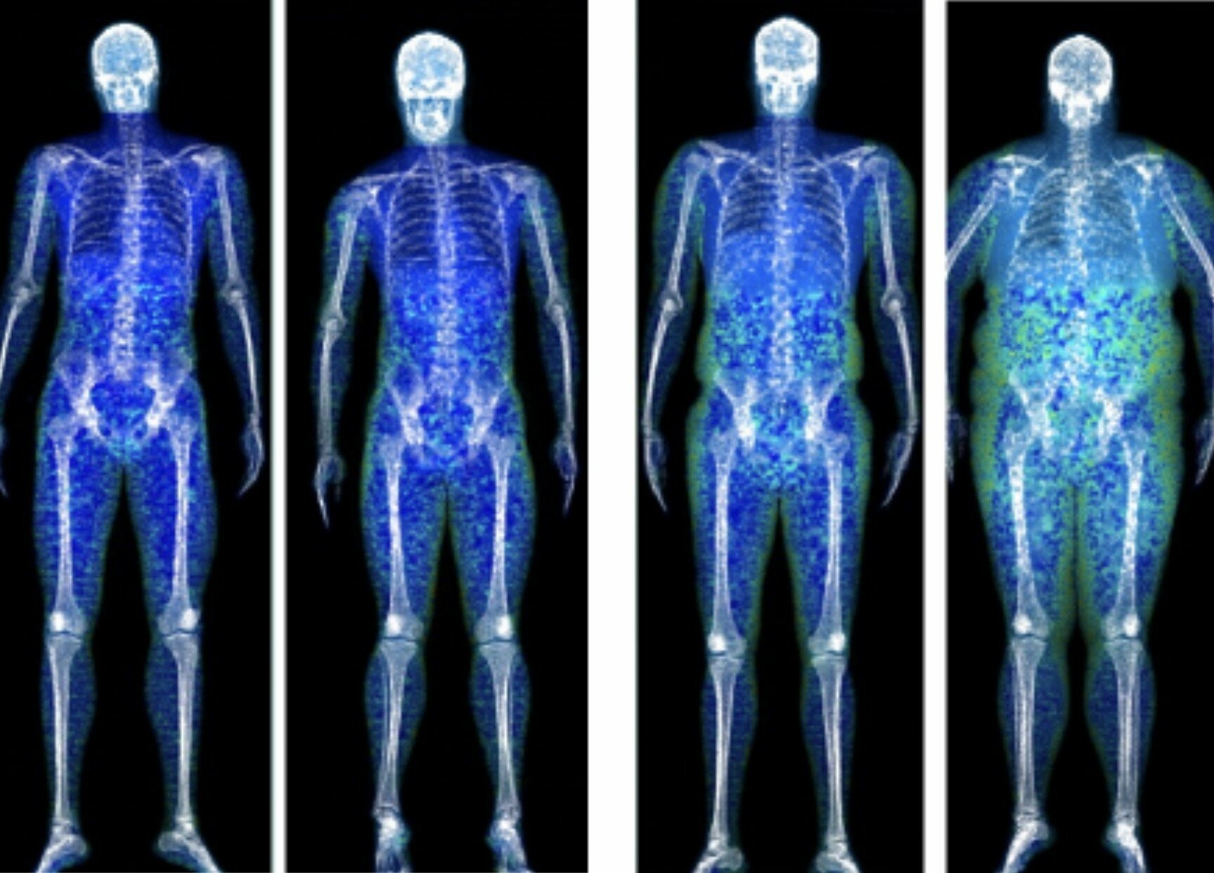 Il grasso nei muscoli &egrave; il pi&ugrave; pericoloso