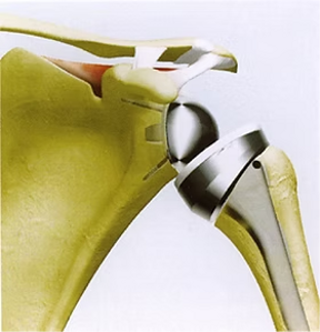 Illustrazione di una protesi di spalla per chirurgia e riabilitazione postoperatoria.