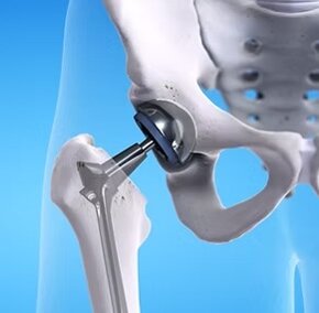 Protesi d'anca per chirurgia ortopedica