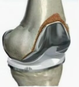 Immagine di una protesi al ginocchio che mostra l'articolazione del ginocchio con impianto chirurgico.