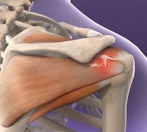 Illustrazione medica della spalla con muscoli e ossa, focus sulla chirurgia ortopedica