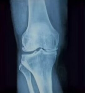 Radiografia di un ginocchio, protesi ginocchio, chirurgia ginocchio