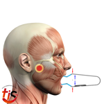 spring-device-dispositivo-per-stretching-mandibolare-tmd