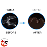 no-brux-bite-termoformanti-economici-contro-bruxismo