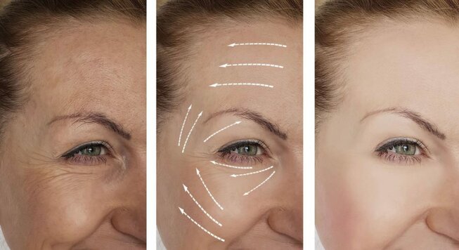 Radiofrequenza Viso Napoli