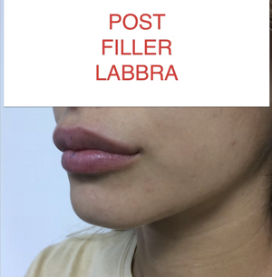 Filler Labbra Risultato