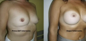 eyJpdCI6IlByaW1hIGUgRG9wbyBJbnRlcnZlbnRvIE1hc3RvcGxhc3RpY2EgQWRkaXRpdmEgYSBOYXBvbGkiLCJlbiI6IkJlZm9yZSBhbmQgQWZ0ZXIgQnJlYXN0IEF1Z21lbnRhdGlvbiBTdXJnZXJ5IGluIE5hcGxlcyJ9 eyJpdCI6IlByaW1hIGUgRG9wbyBJbnRlcnZlbnRvIE1hc3RvcGxhc3RpY2EgQWRkaXRpdmEgYSBOYXBvbGkiLCJlbiI6IkJlZm9yZSBhbmQgQWZ0ZXIgQnJlYXN0IEF1Z21lbnRhdGlvbiBTdXJnZXJ5IGluIE5hcGxlcyJ9