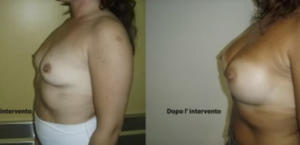 eyJpdCI6IlByaW1hIGUgRG9wbyBJbnRlcnZlbnRvIE1hc3RvcGxhc3RpY2EgQWRkaXRpdmEgYSBOYXBvbGkiLCJlbiI6IkJlZm9yZSBhbmQgQWZ0ZXIgQnJlYXN0IEF1Z21lbnRhdGlvbiBTdXJnZXJ5IGluIE5hcGxlcyJ9 eyJpdCI6IlByaW1hIGUgRG9wbyBJbnRlcnZlbnRvIE1hc3RvcGxhc3RpY2EgQWRkaXRpdmEgYSBOYXBvbGkiLCJlbiI6IkJlZm9yZSBhbmQgQWZ0ZXIgQnJlYXN0IEF1Z21lbnRhdGlvbiBTdXJnZXJ5IGluIE5hcGxlcyJ9