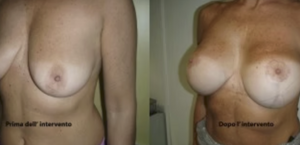 eyJpdCI6IlByaW1hIGUgRG9wbyBJbnRlcnZlbnRvIE1hc3RvcGxhc3RpY2EgQWRkaXRpdmEgYSBOYXBvbGkiLCJlbiI6IkJlZm9yZSBhbmQgQWZ0ZXIgQnJlYXN0IEF1Z21lbnRhdGlvbiBTdXJnZXJ5IGluIE5hcGxlcyJ9 eyJpdCI6IlByaW1hIGUgRG9wbyBJbnRlcnZlbnRvIE1hc3RvcGxhc3RpY2EgQWRkaXRpdmEgYSBOYXBvbGkiLCJlbiI6IkJlZm9yZSBhbmQgQWZ0ZXIgQnJlYXN0IEF1Z21lbnRhdGlvbiBTdXJnZXJ5IGluIE5hcGxlcyJ9