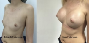 eyJpdCI6IlByaW1hIGUgRG9wbyBJbnRlcnZlbnRvIE1hc3RvcGxhc3RpY2EgQWRkaXRpdmEgYSBOYXBvbGkiLCJlbiI6IkJlZm9yZSBhbmQgQWZ0ZXIgQnJlYXN0IEF1Z21lbnRhdGlvbiBTdXJnZXJ5IGluIE5hcGxlcyJ9 eyJpdCI6IlByaW1hIGUgRG9wbyBJbnRlcnZlbnRvIE1hc3RvcGxhc3RpY2EgQWRkaXRpdmEgYSBOYXBvbGkiLCJlbiI6IkJlZm9yZSBhbmQgQWZ0ZXIgQnJlYXN0IEF1Z21lbnRhdGlvbiBTdXJnZXJ5IGluIE5hcGxlcyJ9