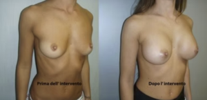 eyJpdCI6IlByaW1hIGUgRG9wbyBJbnRlcnZlbnRvIE1hc3RvcGxhc3RpY2EgQWRkaXRpdmEgYSBOYXBvbGkiLCJlbiI6IkJlZm9yZSBhbmQgQWZ0ZXIgQnJlYXN0IEF1Z21lbnRhdGlvbiBTdXJnZXJ5IGluIE5hcGxlcyJ9 eyJpdCI6IlByaW1hIGUgRG9wbyBJbnRlcnZlbnRvIE1hc3RvcGxhc3RpY2EgQWRkaXRpdmEgYSBOYXBvbGkiLCJlbiI6IkJlZm9yZSBhbmQgQWZ0ZXIgQnJlYXN0IEF1Z21lbnRhdGlvbiBTdXJnZXJ5IGluIE5hcGxlcyJ9