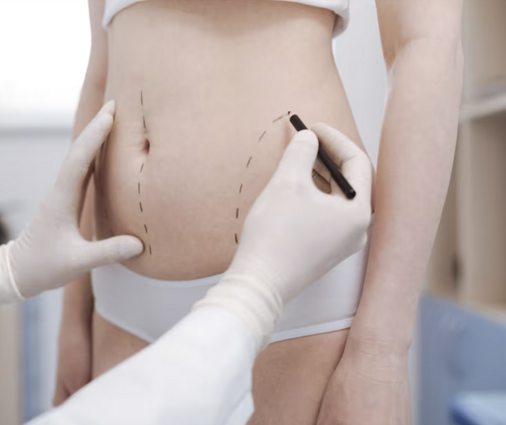 Intervento Liposuzione Napoli