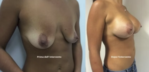 eyJpdCI6IlByaW1hIGUgRG9wbyBJbnRlcnZlbnRvIE1hc3RvcGxhc3RpY2EgQWRkaXRpdmEgYSBOYXBvbGkiLCJlbiI6IkJlZm9yZSBhbmQgQWZ0ZXIgQnJlYXN0IEF1Z21lbnRhdGlvbiBTdXJnZXJ5IGluIE5hcGxlcyJ9 eyJpdCI6IlByaW1hIGUgRG9wbyBJbnRlcnZlbnRvIE1hc3RvcGxhc3RpY2EgQWRkaXRpdmEgYSBOYXBvbGkiLCJlbiI6IkJlZm9yZSBhbmQgQWZ0ZXIgQnJlYXN0IEF1Z21lbnRhdGlvbiBTdXJnZXJ5IGluIE5hcGxlcyJ9