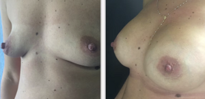 eyJpdCI6IlByaW1hIGUgRG9wbyBJbnRlcnZlbnRvIE1hc3RvcGxhc3RpY2EgQWRkaXRpdmEgYSBOYXBvbGkiLCJlbiI6IkJlZm9yZSBhbmQgQWZ0ZXIgQnJlYXN0IEF1Z21lbnRhdGlvbiBTdXJnZXJ5IGluIE5hcGxlcyJ9 eyJpdCI6IlByaW1hIGUgRG9wbyBJbnRlcnZlbnRvIE1hc3RvcGxhc3RpY2EgQWRkaXRpdmEgYSBOYXBvbGkiLCJlbiI6IkJlZm9yZSBhbmQgQWZ0ZXIgQnJlYXN0IEF1Z21lbnRhdGlvbiBTdXJnZXJ5IGluIE5hcGxlcyJ9