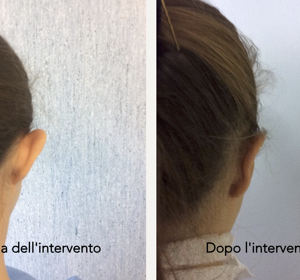 Prima e Dopo Intervento Otoplastica Napoli 