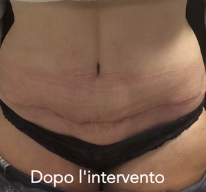 Intervento Addominoplastica Dopo l'intervento 