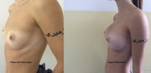 eyJpdCI6IlByaW1hIGUgRG9wbyBJbnRlcnZlbnRvIE1hc3RvcGxhc3RpY2EgQWRkaXRpdmEgYSBOYXBvbGkiLCJlbiI6IkJlZm9yZSBhbmQgQWZ0ZXIgQnJlYXN0IEF1Z21lbnRhdGlvbiBTdXJnZXJ5IGluIE5hcGxlcyJ9 eyJpdCI6IlByaW1hIGUgRG9wbyBJbnRlcnZlbnRvIE1hc3RvcGxhc3RpY2EgQWRkaXRpdmEgYSBOYXBvbGkiLCJlbiI6IkJlZm9yZSBhbmQgQWZ0ZXIgQnJlYXN0IEF1Z21lbnRhdGlvbiBTdXJnZXJ5IGluIE5hcGxlcyJ9