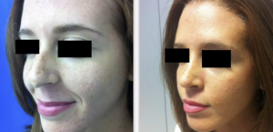 eyJpdCI6IlByaW1hIGUgRG9wbyBJbnRlcnZlbnRvIFJpbm9wbGFzdGljYSBhIE5hcG9saSIsImVuIjoiQmVmb3JlIGFuZCBBZnRlciBSaGlub3BsYXN0eSBTdXJnZXJ5IGluIE5hcGxlcyJ9