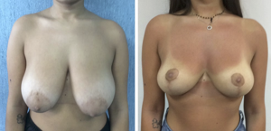 Prima e Dopo Intervento Mastoplastica Riduttiva a Napoli