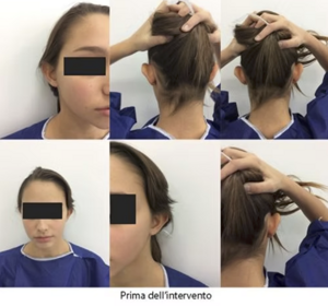 Prima e Dopo Intervento Otoplastica Napoli 