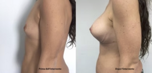 eyJpdCI6IlByaW1hIGUgRG9wbyBJbnRlcnZlbnRvIE1hc3RvcGxhc3RpY2EgQWRkaXRpdmEgYSBOYXBvbGkiLCJlbiI6IkJlZm9yZSBhbmQgQWZ0ZXIgQnJlYXN0IEF1Z21lbnRhdGlvbiBTdXJnZXJ5IGluIE5hcGxlcyJ9 eyJpdCI6IlByaW1hIGUgRG9wbyBJbnRlcnZlbnRvIE1hc3RvcGxhc3RpY2EgQWRkaXRpdmEgYSBOYXBvbGkiLCJlbiI6IkJlZm9yZSBhbmQgQWZ0ZXIgQnJlYXN0IEF1Z21lbnRhdGlvbiBTdXJnZXJ5IGluIE5hcGxlcyJ9