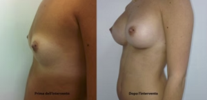 eyJpdCI6IlByaW1hIGUgRG9wbyBJbnRlcnZlbnRvIE1hc3RvcGxhc3RpY2EgQWRkaXRpdmEgYSBOYXBvbGkiLCJlbiI6IkJlZm9yZSBhbmQgQWZ0ZXIgQnJlYXN0IEF1Z21lbnRhdGlvbiBTdXJnZXJ5IGluIE5hcGxlcyJ9 eyJpdCI6IlByaW1hIGUgRG9wbyBJbnRlcnZlbnRvIE1hc3RvcGxhc3RpY2EgQWRkaXRpdmEgYSBOYXBvbGkiLCJlbiI6IkJlZm9yZSBhbmQgQWZ0ZXIgQnJlYXN0IEF1Z21lbnRhdGlvbiBTdXJnZXJ5IGluIE5hcGxlcyJ9