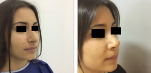 eyJpdCI6IlByaW1hIGUgRG9wbyBJbnRlcnZlbnRvIFJpbm9wbGFzdGljYSBhIE5hcG9saSIsImVuIjoiQmVmb3JlIGFuZCBBZnRlciBSaGlub3BsYXN0eSBTdXJnZXJ5IGluIE5hcGxlcyJ9