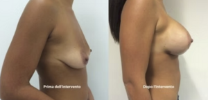 eyJpdCI6IlByaW1hIGUgRG9wbyBJbnRlcnZlbnRvIE1hc3RvcGxhc3RpY2EgQWRkaXRpdmEgYSBOYXBvbGkiLCJlbiI6IkJlZm9yZSBhbmQgQWZ0ZXIgQnJlYXN0IEF1Z21lbnRhdGlvbiBTdXJnZXJ5IGluIE5hcGxlcyJ9 eyJpdCI6IlByaW1hIGUgRG9wbyBJbnRlcnZlbnRvIE1hc3RvcGxhc3RpY2EgQWRkaXRpdmEgYSBOYXBvbGkiLCJlbiI6IkJlZm9yZSBhbmQgQWZ0ZXIgQnJlYXN0IEF1Z21lbnRhdGlvbiBTdXJnZXJ5IGluIE5hcGxlcyJ9