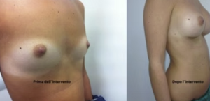 eyJpdCI6IlByaW1hIGUgRG9wbyBJbnRlcnZlbnRvIE1hc3RvcGxhc3RpY2EgQWRkaXRpdmEgYSBOYXBvbGkiLCJlbiI6IkJlZm9yZSBhbmQgQWZ0ZXIgQnJlYXN0IEF1Z21lbnRhdGlvbiBTdXJnZXJ5IGluIE5hcGxlcyJ9 eyJpdCI6IlByaW1hIGUgRG9wbyBJbnRlcnZlbnRvIE1hc3RvcGxhc3RpY2EgQWRkaXRpdmEgYSBOYXBvbGkiLCJlbiI6IkJlZm9yZSBhbmQgQWZ0ZXIgQnJlYXN0IEF1Z21lbnRhdGlvbiBTdXJnZXJ5IGluIE5hcGxlcyJ9