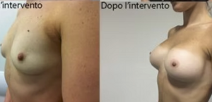 eyJpdCI6IlByaW1hIGUgRG9wbyBJbnRlcnZlbnRvIE1hc3RvcGxhc3RpY2EgQWRkaXRpdmEgYSBOYXBvbGkiLCJlbiI6IkJlZm9yZSBhbmQgQWZ0ZXIgQnJlYXN0IEF1Z21lbnRhdGlvbiBTdXJnZXJ5IGluIE5hcGxlcyJ9 eyJpdCI6IlByaW1hIGUgRG9wbyBJbnRlcnZlbnRvIE1hc3RvcGxhc3RpY2EgQWRkaXRpdmEgYSBOYXBvbGkiLCJlbiI6IkJlZm9yZSBhbmQgQWZ0ZXIgQnJlYXN0IEF1Z21lbnRhdGlvbiBTdXJnZXJ5IGluIE5hcGxlcyJ9