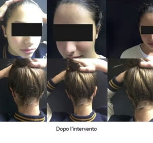 Prima e Dopo Intervento Otoplastica Napoli 