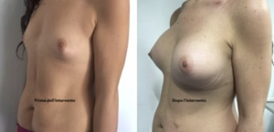 eyJpdCI6IlByaW1hIGUgRG9wbyBJbnRlcnZlbnRvIE1hc3RvcGxhc3RpY2EgQWRkaXRpdmEgYSBOYXBvbGkiLCJlbiI6IkJlZm9yZSBhbmQgQWZ0ZXIgQnJlYXN0IEF1Z21lbnRhdGlvbiBTdXJnZXJ5IGluIE5hcGxlcyJ9 eyJpdCI6IlByaW1hIGUgRG9wbyBJbnRlcnZlbnRvIE1hc3RvcGxhc3RpY2EgQWRkaXRpdmEgYSBOYXBvbGkiLCJlbiI6IkJlZm9yZSBhbmQgQWZ0ZXIgQnJlYXN0IEF1Z21lbnRhdGlvbiBTdXJnZXJ5IGluIE5hcGxlcyJ9