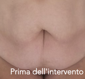 Intervento Addominoplastica Prima l'intervento 