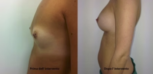 eyJpdCI6IlByaW1hIGUgRG9wbyBJbnRlcnZlbnRvIE1hc3RvcGxhc3RpY2EgQWRkaXRpdmEgYSBOYXBvbGkiLCJlbiI6IkJlZm9yZSBhbmQgQWZ0ZXIgQnJlYXN0IEF1Z21lbnRhdGlvbiBTdXJnZXJ5IGluIE5hcGxlcyJ9 eyJpdCI6IlByaW1hIGUgRG9wbyBJbnRlcnZlbnRvIE1hc3RvcGxhc3RpY2EgQWRkaXRpdmEgYSBOYXBvbGkiLCJlbiI6IkJlZm9yZSBhbmQgQWZ0ZXIgQnJlYXN0IEF1Z21lbnRhdGlvbiBTdXJnZXJ5IGluIE5hcGxlcyJ9