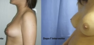 eyJpdCI6IlByaW1hIGUgRG9wbyBJbnRlcnZlbnRvIE1hc3RvcGxhc3RpY2EgQWRkaXRpdmEgYSBOYXBvbGkiLCJlbiI6IkJlZm9yZSBhbmQgQWZ0ZXIgQnJlYXN0IEF1Z21lbnRhdGlvbiBTdXJnZXJ5IGluIE5hcGxlcyJ9 eyJpdCI6IlByaW1hIGUgRG9wbyBJbnRlcnZlbnRvIE1hc3RvcGxhc3RpY2EgQWRkaXRpdmEgYSBOYXBvbGkiLCJlbiI6IkJlZm9yZSBhbmQgQWZ0ZXIgQnJlYXN0IEF1Z21lbnRhdGlvbiBTdXJnZXJ5IGluIE5hcGxlcyJ9