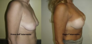 eyJpdCI6IlByaW1hIGUgRG9wbyBJbnRlcnZlbnRvIE1hc3RvcGxhc3RpY2EgQWRkaXRpdmEgYSBOYXBvbGkiLCJlbiI6IkJlZm9yZSBhbmQgQWZ0ZXIgQnJlYXN0IEF1Z21lbnRhdGlvbiBTdXJnZXJ5IGluIE5hcGxlcyJ9 eyJpdCI6IlByaW1hIGUgRG9wbyBJbnRlcnZlbnRvIE1hc3RvcGxhc3RpY2EgQWRkaXRpdmEgYSBOYXBvbGkiLCJlbiI6IkJlZm9yZSBhbmQgQWZ0ZXIgQnJlYXN0IEF1Z21lbnRhdGlvbiBTdXJnZXJ5IGluIE5hcGxlcyJ9