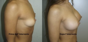 eyJpdCI6IlByaW1hIGUgRG9wbyBJbnRlcnZlbnRvIE1hc3RvcGxhc3RpY2EgQWRkaXRpdmEgYSBOYXBvbGkiLCJlbiI6IkJlZm9yZSBhbmQgQWZ0ZXIgQnJlYXN0IEF1Z21lbnRhdGlvbiBTdXJnZXJ5IGluIE5hcGxlcyJ9 eyJpdCI6IlByaW1hIGUgRG9wbyBJbnRlcnZlbnRvIE1hc3RvcGxhc3RpY2EgQWRkaXRpdmEgYSBOYXBvbGkiLCJlbiI6IkJlZm9yZSBhbmQgQWZ0ZXIgQnJlYXN0IEF1Z21lbnRhdGlvbiBTdXJnZXJ5IGluIE5hcGxlcyJ9