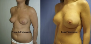 eyJpdCI6IlByaW1hIGUgRG9wbyBJbnRlcnZlbnRvIE1hc3RvcGxhc3RpY2EgQWRkaXRpdmEgYSBOYXBvbGkiLCJlbiI6IkJlZm9yZSBhbmQgQWZ0ZXIgQnJlYXN0IEF1Z21lbnRhdGlvbiBTdXJnZXJ5IGluIE5hcGxlcyJ9 eyJpdCI6IlByaW1hIGUgRG9wbyBJbnRlcnZlbnRvIE1hc3RvcGxhc3RpY2EgQWRkaXRpdmEgYSBOYXBvbGkiLCJlbiI6IkJlZm9yZSBhbmQgQWZ0ZXIgQnJlYXN0IEF1Z21lbnRhdGlvbiBTdXJnZXJ5IGluIE5hcGxlcyJ9