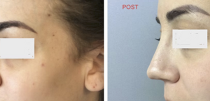 eyJpdCI6IlByaW1hIGUgRG9wbyBJbnRlcnZlbnRvIFJpbm9wbGFzdGljYSBhIE5hcG9saSIsImVuIjoiQmVmb3JlIGFuZCBBZnRlciBSaGlub3BsYXN0eSBTdXJnZXJ5IGluIE5hcGxlcyJ9