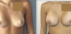 eyJpdCI6IlByaW1hIGUgRG9wbyBJbnRlcnZlbnRvIE1hc3RvcGxhc3RpY2EgQWRkaXRpdmEgYSBOYXBvbGkiLCJlbiI6IkJlZm9yZSBhbmQgQWZ0ZXIgQnJlYXN0IEF1Z21lbnRhdGlvbiBTdXJnZXJ5IGluIE5hcGxlcyJ9 eyJpdCI6IlByaW1hIGUgRG9wbyBJbnRlcnZlbnRvIE1hc3RvcGxhc3RpY2EgQWRkaXRpdmEgYSBOYXBvbGkiLCJlbiI6IkJlZm9yZSBhbmQgQWZ0ZXIgQnJlYXN0IEF1Z21lbnRhdGlvbiBTdXJnZXJ5IGluIE5hcGxlcyJ9