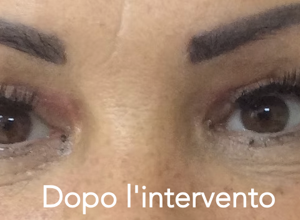 eyJpdCI6IiBCbGVmYXJvcGxhc3RpY2EgTmFwb2xpIGRvcG8gbCcgaW50ZXJ2ZW50byIsImVuIjoiIEJsZXBoYXJvcGxhc3R5IE5hcGxlcyBhZnRlciB0aGUgc3VyZ2VyeSJ9