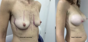 eyJpdCI6IlByaW1hIGUgRG9wbyBJbnRlcnZlbnRvIE1hc3RvcGxhc3RpY2EgQWRkaXRpdmEgYSBOYXBvbGkiLCJlbiI6IkJlZm9yZSBhbmQgQWZ0ZXIgQnJlYXN0IEF1Z21lbnRhdGlvbiBTdXJnZXJ5IGluIE5hcGxlcyJ9 eyJpdCI6IlByaW1hIGUgRG9wbyBJbnRlcnZlbnRvIE1hc3RvcGxhc3RpY2EgQWRkaXRpdmEgYSBOYXBvbGkiLCJlbiI6IkJlZm9yZSBhbmQgQWZ0ZXIgQnJlYXN0IEF1Z21lbnRhdGlvbiBTdXJnZXJ5IGluIE5hcGxlcyJ9