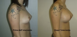 eyJpdCI6IlByaW1hIGUgRG9wbyBJbnRlcnZlbnRvIE1hc3RvcGxhc3RpY2EgQWRkaXRpdmEgYSBOYXBvbGkiLCJlbiI6IkJlZm9yZSBhbmQgQWZ0ZXIgQnJlYXN0IEF1Z21lbnRhdGlvbiBTdXJnZXJ5IGluIE5hcGxlcyJ9 eyJpdCI6IlByaW1hIGUgRG9wbyBJbnRlcnZlbnRvIE1hc3RvcGxhc3RpY2EgQWRkaXRpdmEgYSBOYXBvbGkiLCJlbiI6IkJlZm9yZSBhbmQgQWZ0ZXIgQnJlYXN0IEF1Z21lbnRhdGlvbiBTdXJnZXJ5IGluIE5hcGxlcyJ9