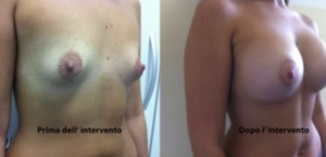 eyJpdCI6IlByaW1hIGUgRG9wbyBJbnRlcnZlbnRvIE1hc3RvcGxhc3RpY2EgQWRkaXRpdmEgYSBOYXBvbGkiLCJlbiI6IkJlZm9yZSBhbmQgQWZ0ZXIgQnJlYXN0IEF1Z21lbnRhdGlvbiBTdXJnZXJ5IGluIE5hcGxlcyJ9 eyJpdCI6IlByaW1hIGUgRG9wbyBJbnRlcnZlbnRvIE1hc3RvcGxhc3RpY2EgQWRkaXRpdmEgYSBOYXBvbGkiLCJlbiI6IkJlZm9yZSBhbmQgQWZ0ZXIgQnJlYXN0IEF1Z21lbnRhdGlvbiBTdXJnZXJ5IGluIE5hcGxlcyJ9