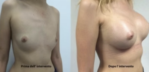 eyJpdCI6IlByaW1hIGUgRG9wbyBJbnRlcnZlbnRvIE1hc3RvcGxhc3RpY2EgQWRkaXRpdmEgYSBOYXBvbGkiLCJlbiI6IkJlZm9yZSBhbmQgQWZ0ZXIgQnJlYXN0IEF1Z21lbnRhdGlvbiBTdXJnZXJ5IGluIE5hcGxlcyJ9 eyJpdCI6IlByaW1hIGUgRG9wbyBJbnRlcnZlbnRvIE1hc3RvcGxhc3RpY2EgQWRkaXRpdmEgYSBOYXBvbGkiLCJlbiI6IkJlZm9yZSBhbmQgQWZ0ZXIgQnJlYXN0IEF1Z21lbnRhdGlvbiBTdXJnZXJ5IGluIE5hcGxlcyJ9