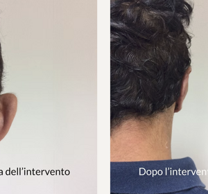 Prima e Dopo Intervento Otoplastica Napoli 