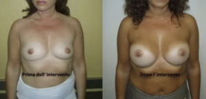 eyJpdCI6IlByaW1hIGUgRG9wbyBJbnRlcnZlbnRvIE1hc3RvcGxhc3RpY2EgQWRkaXRpdmEgYSBOYXBvbGkiLCJlbiI6IkJlZm9yZSBhbmQgQWZ0ZXIgQnJlYXN0IEF1Z21lbnRhdGlvbiBTdXJnZXJ5IGluIE5hcGxlcyJ9 eyJpdCI6IlByaW1hIGUgRG9wbyBJbnRlcnZlbnRvIE1hc3RvcGxhc3RpY2EgQWRkaXRpdmEgYSBOYXBvbGkiLCJlbiI6IkJlZm9yZSBhbmQgQWZ0ZXIgQnJlYXN0IEF1Z21lbnRhdGlvbiBTdXJnZXJ5IGluIE5hcGxlcyJ9