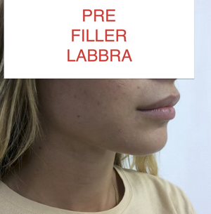 Filler Labra Risultato