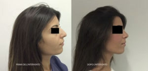 eyJpdCI6IlByaW1hIGUgRG9wbyBJbnRlcnZlbnRvIFJpbm9wbGFzdGljYSBhIE5hcG9saSIsImVuIjoiQmVmb3JlIGFuZCBBZnRlciBSaGlub3BsYXN0eSBTdXJnZXJ5IGluIE5hcGxlcyJ9